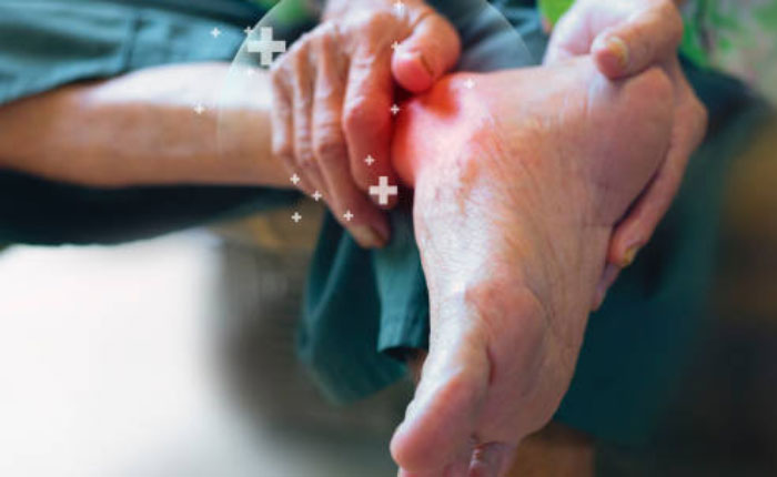 điều trị gout
